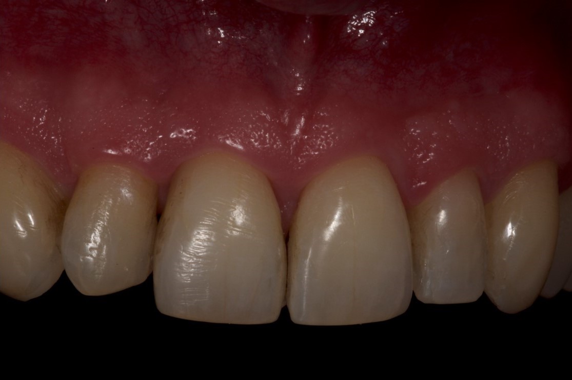 Cosmetic Bonding Halifax, NS Dr. Jenine Arab Omalley